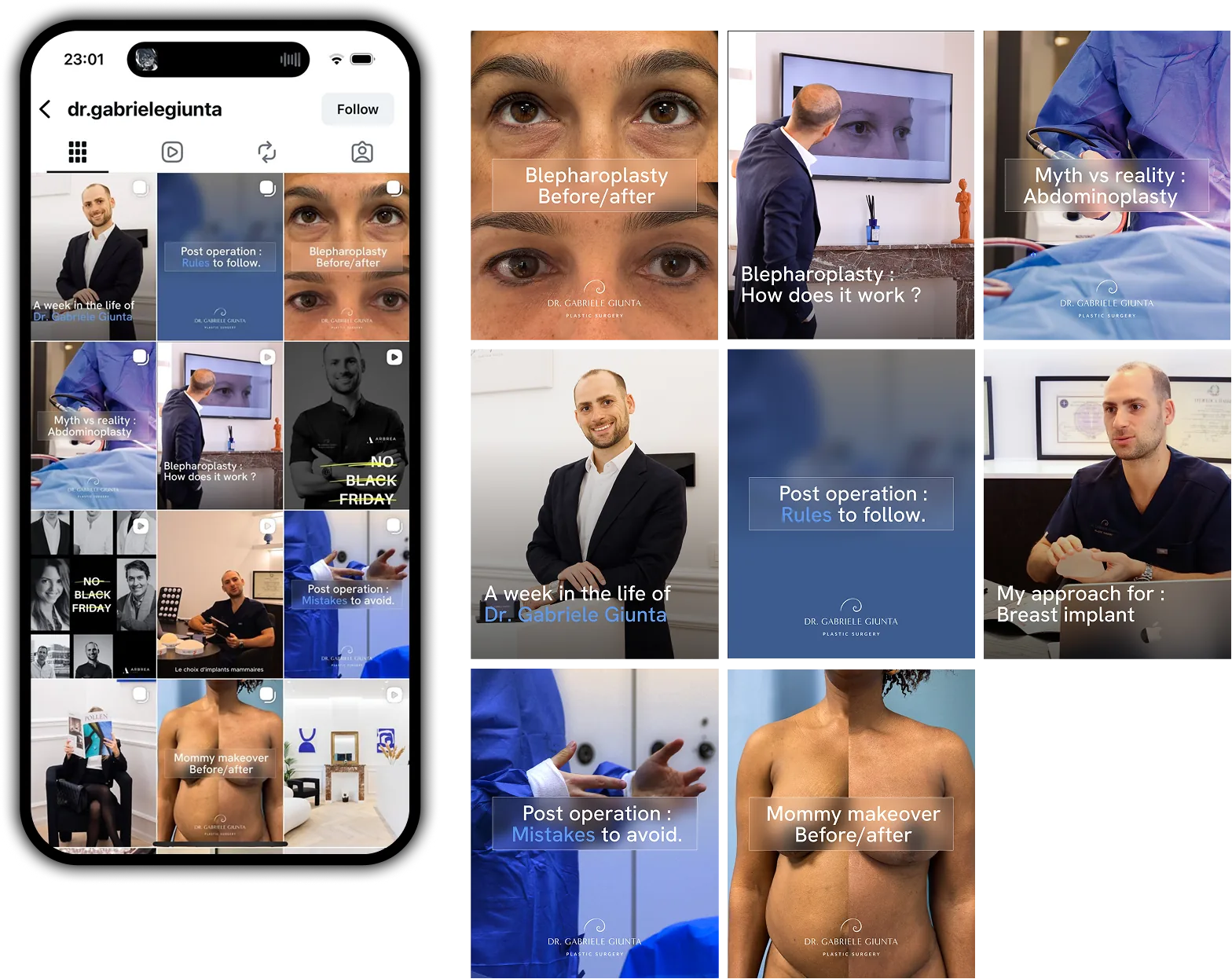 Dr. Gabriele Giunta Instagram grid and new post concept: before/after, myth vs reality, rules and mistakes after surgery